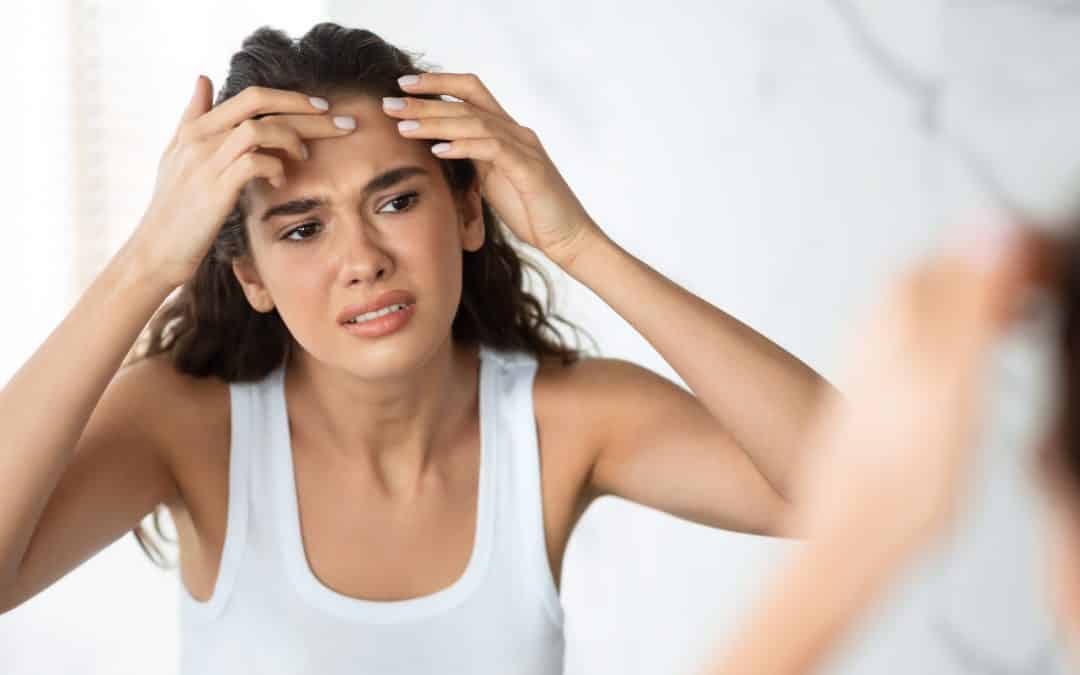 Woman with Hormonal Acne Looking at the Mirror
