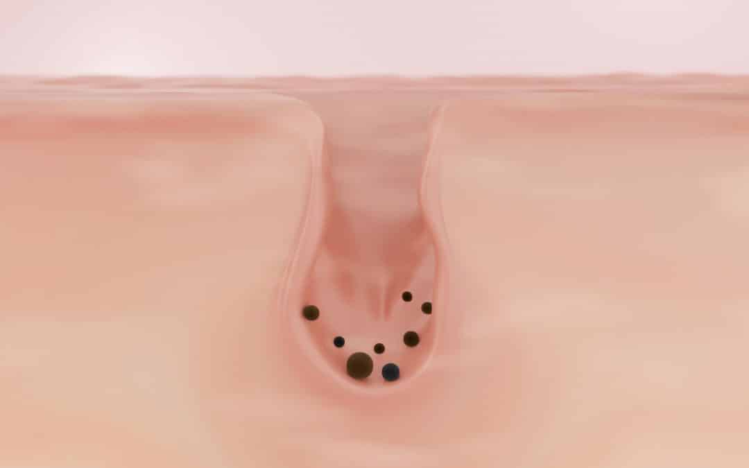 Blackheads