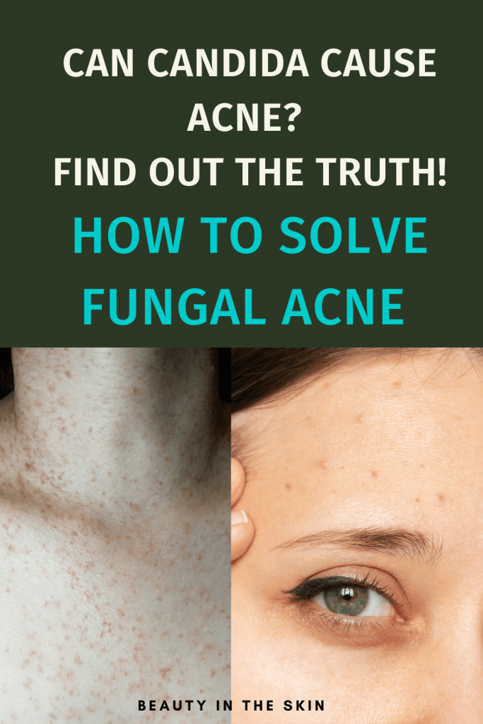 Pin for Pinterest: Can Candida Cause Acne?