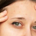 Cover Image: Girl With Fungal Acne