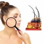 Cover Image, Young woman with rosacea under magnifying glass