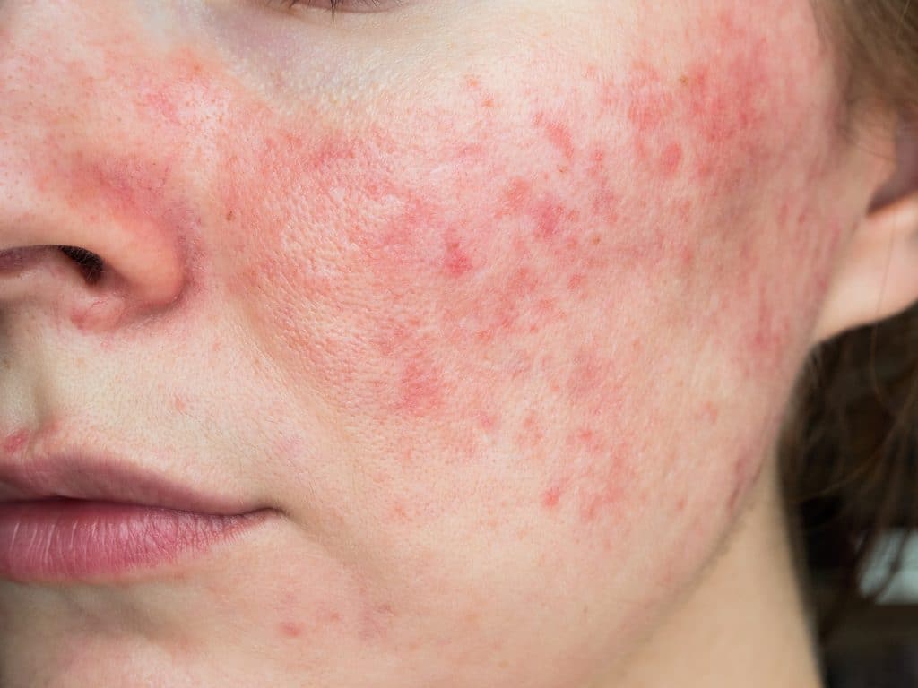 Young woman with rosacea