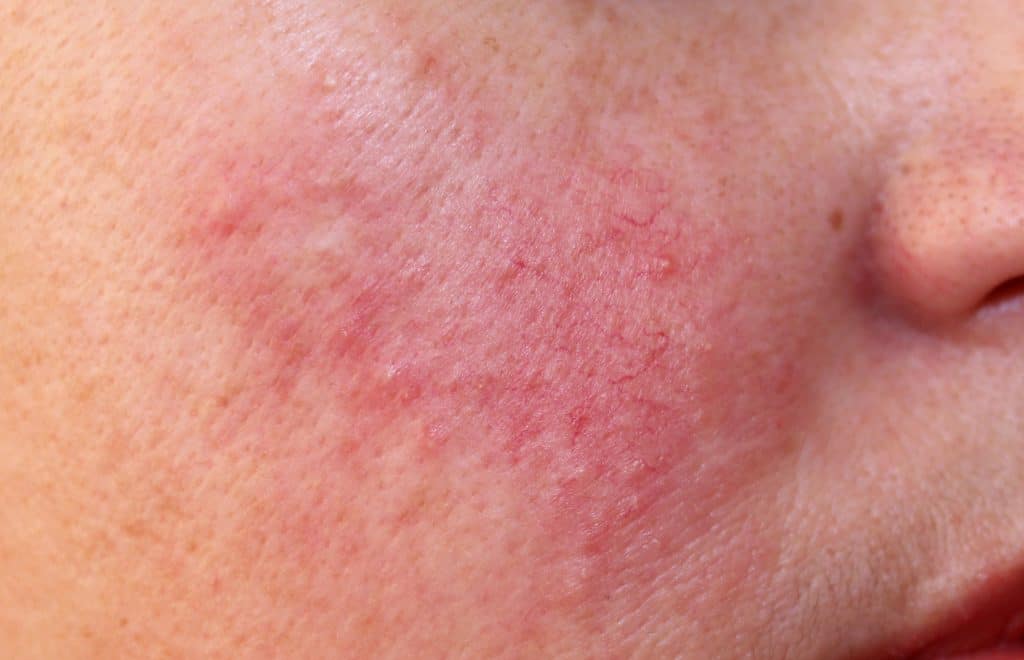 Skin with rosacea