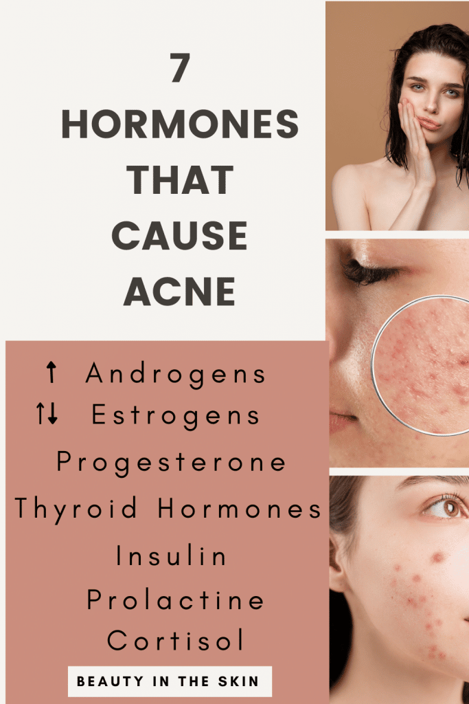 Infographics: 7 hormones that cause hormonal acne