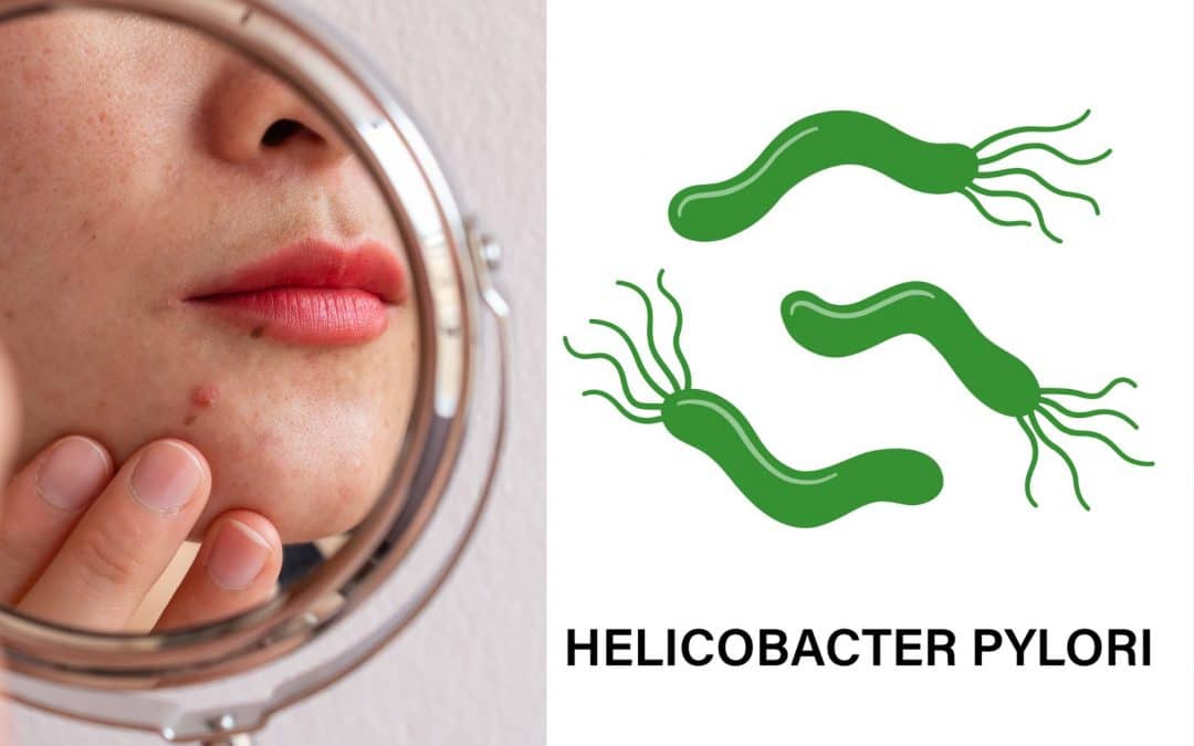 Can Helicobacter Pylori Cause Acne and Rosacea? Find Out!